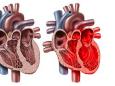 Fall eines Happy-Heart-Syndroms: Zu viel empfundenes Glück kann das Herz brechen