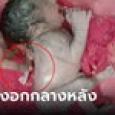 ภาพหายาก แขนที่ 3 งอกกลางหลังทารก แตะปุ๊บร้องไห้จ้า หมอเผยพบเพียง 1 ในล้าน