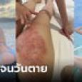 เจ็บแทน! 