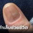ลูกค้าสาวสุดงง ช่างทำเล็บปฏิเสธให้บริการ เตือนให้ไปหาหมอ ที่แท้เป็นโรคหายาก