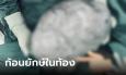 สะพรึง! นึกว่าตัวเองอ้วนขึ้น ที่แท้เป็นโรคถุงน้ำในรังไข่ ขนาดใหญ่หนักถึง 9 กก.