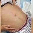 สยอง หญิงท้องผูก 10 วัน แบกท้องโตไปให้หมอผ่าตัด อึออกมา 20 กก. นึกว่างูเหลือม