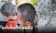 สงสารจับใจ ตัดผมช่วยเด็กน้อย สุดทรมานหนังหัวมีแต่แผล กองทัพเหากระโดดยั้วเยี้ย