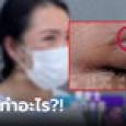 หมอทำอะไร?! ช็อกทำตา 2 ชั้น เปลือกตา 