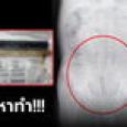 หมอมึน คนไข้สอด 