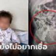 หมอปาดเหงื่อ เจอเคสเด็ก 2 ขวบ กลืนเข็มลงท้อง 8 เล่ม ช็อกซ้ำ แม่เผยเข็มไว้ใช้ทำอะไร